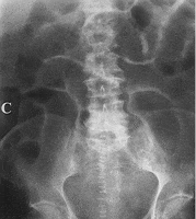 Laparoscopy
